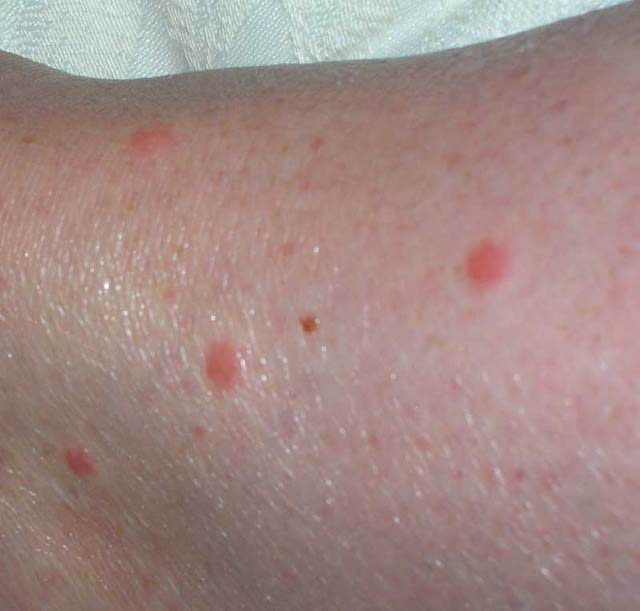 Bed Bugs Bites, in Hotels, Prevention and Treatment, Bed ...